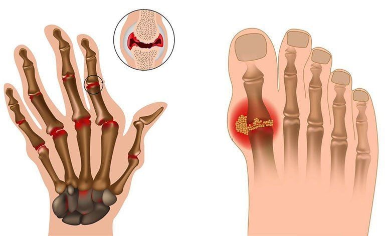 viêm khớp dạng thấp