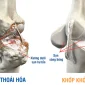 hình ảnh minh họa thoái hóa khớp