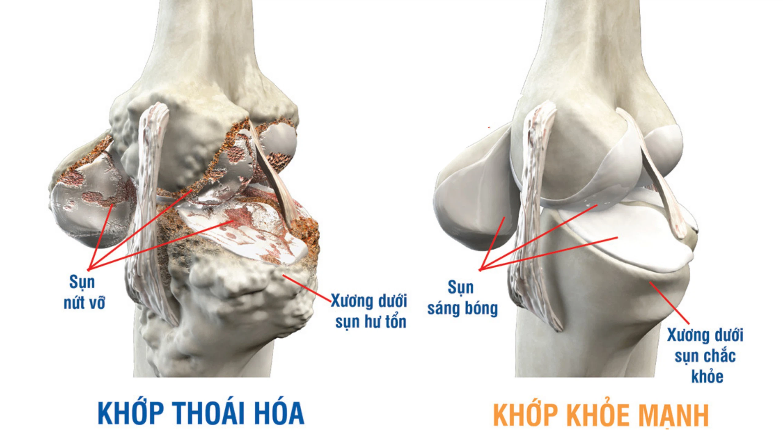 hình ảnh minh họa thoái hóa khớp
