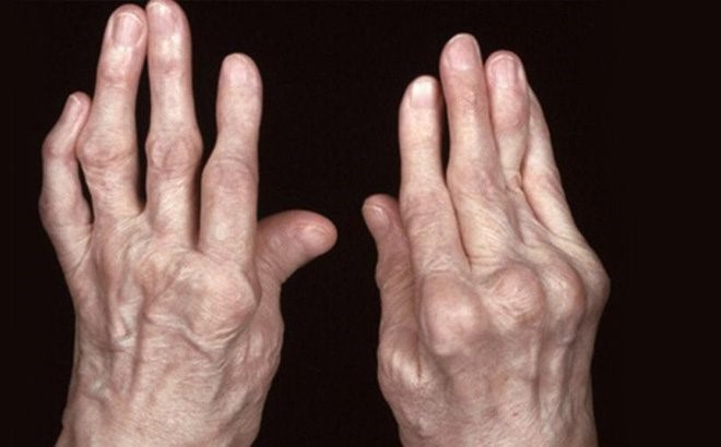 bàn tay bị viêm khớp dạng thấp