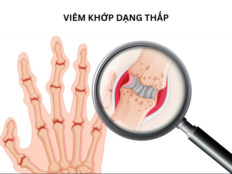 bàn tay bị viêm khớp dạng thấp