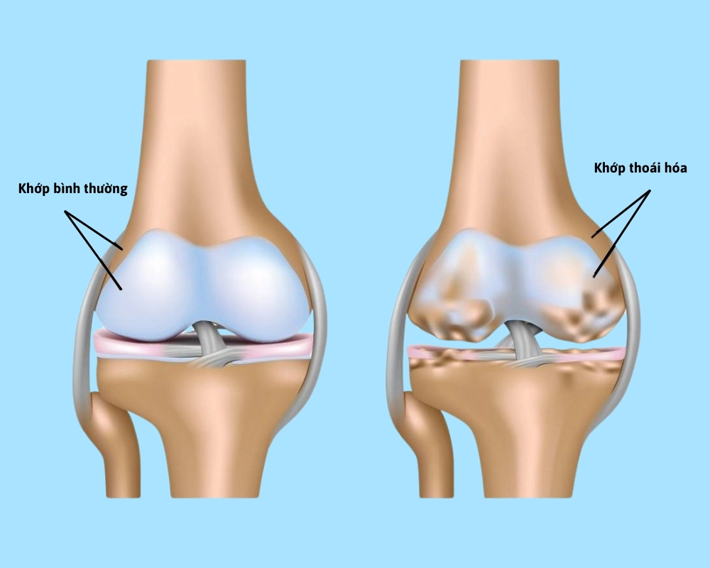 thoái hóa khớp gối