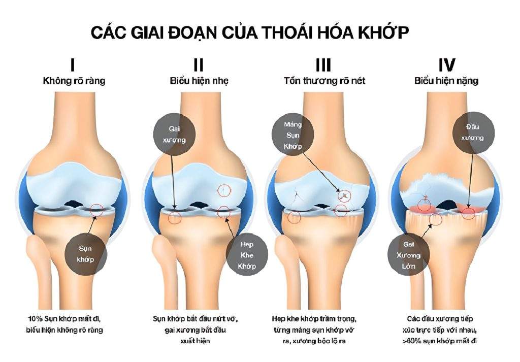 Các giai đoạn thoái hóa khớp