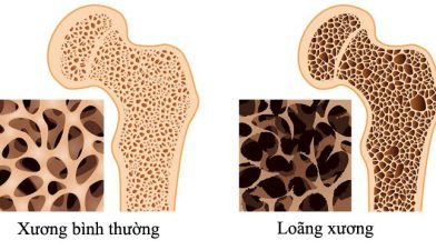 so sánh xương bình thường và xương loãng